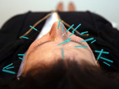 Acupuncture